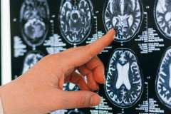 EEG pentru depistarea epilepsiei